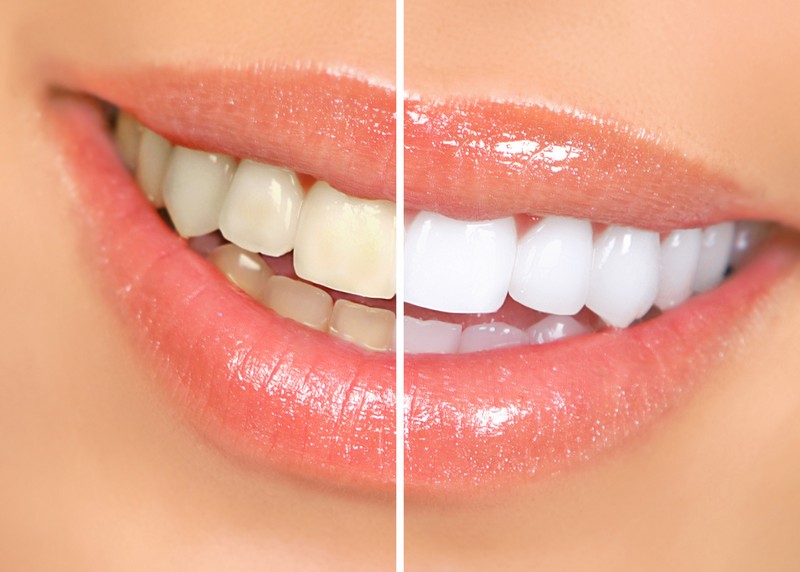 Teeth Whitening  Staten Island, NY 